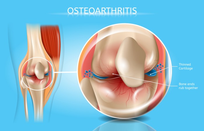 Osteoarthritis treatment in Ayurveda