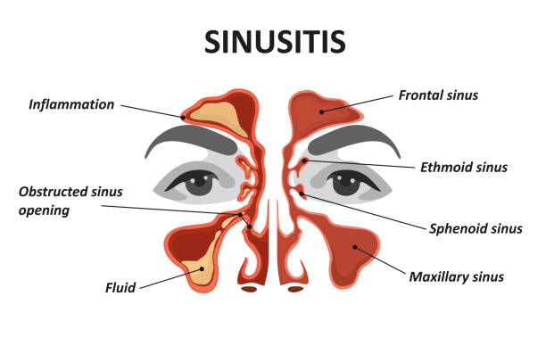 natural sinus infection treatment