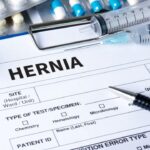Hernia At Work Compensation